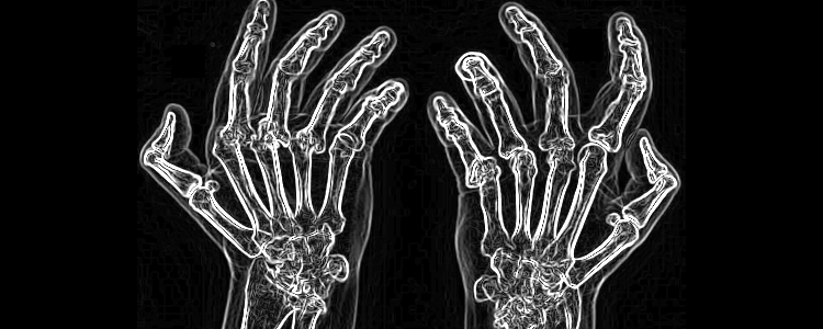 Arthrite rhumatoide sévère aux mains